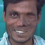 Facial Injuries Due To Electrical Burns