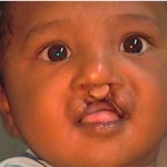 Bilateral Cleft Lip Repair