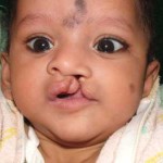 Unilateral Cleft Lip and Palate