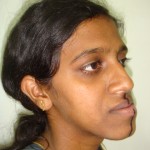 Sushma - A Case Of Mandibular Prognanthism